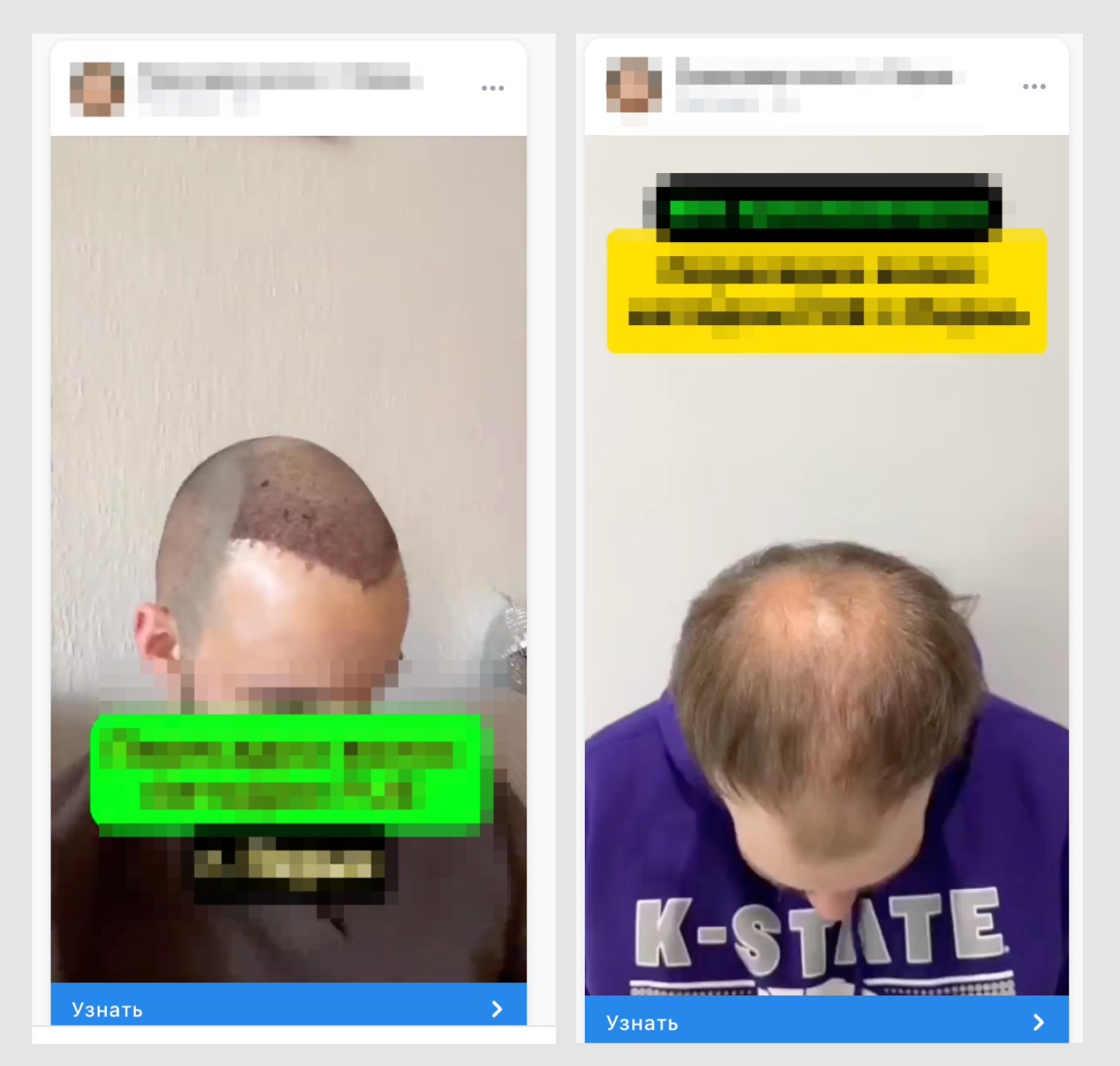 Креативы до и после пересадки волос для VK Ads